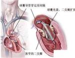 危重风湿性心脏瓣膜病的外科治疗