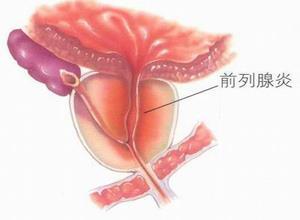 前列腺炎