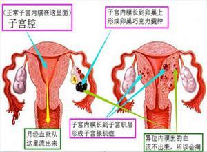 盆腔炎