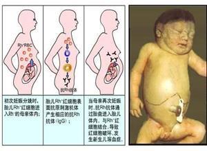 新生儿溶血病