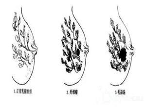 乳房纤维瘤