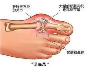 痛风性关节炎