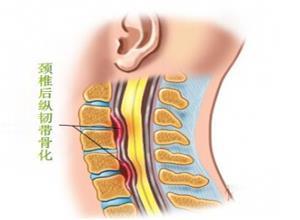 颈椎后纵韧带骨化症