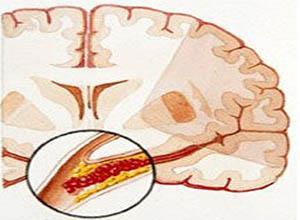 脑血栓形成
