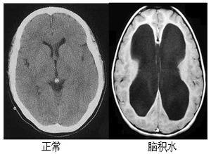 先天性脑积水