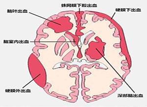 蛛网膜下腔出血