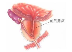 非细菌性前列腺炎