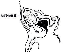 脐尿管囊肿及脐尿管瘘