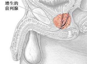 前列腺增生