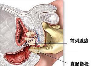 前列腺癌
