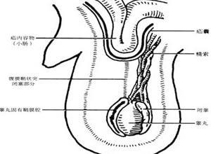 腹股沟斜疝