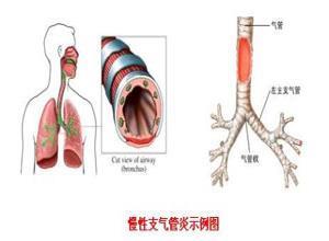 慢性支气管炎