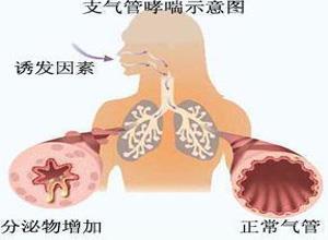 支气管哮喘