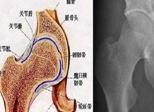股骨头骨骺骨软骨病