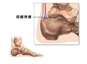 跟腱后滑囊炎