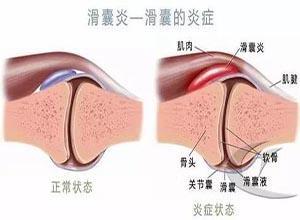 滑囊炎