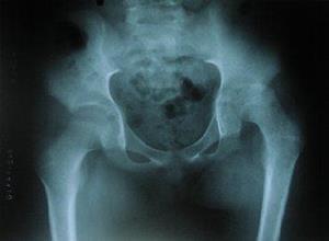 急性血源性骨髓炎