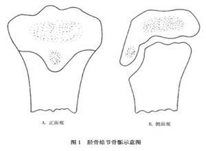 胫骨结节骨软骨病