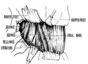 脊椎结核并发窦道