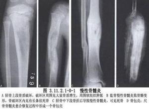 慢性化脓性骨髓炎