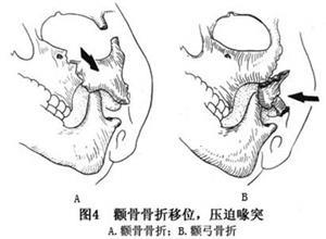 颧骨骨折