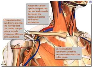 前斜角肌综合征