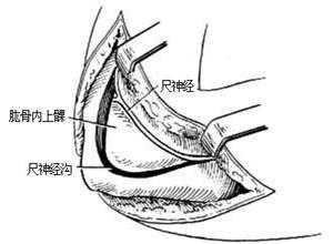 先天性肘关节融合