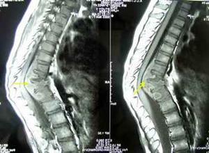 椎管内结核肉芽肿