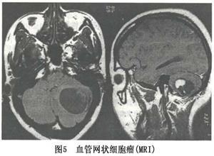 血管网织细胞瘤