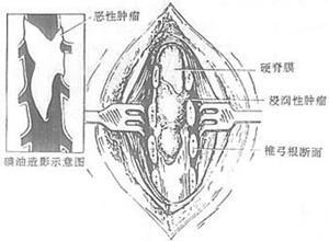 原发性椎管内肿瘤