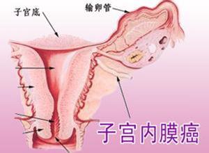 子宫内膜癌