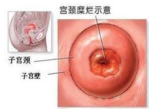 宫颈糜烂