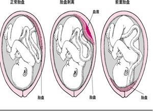 前置胎盘