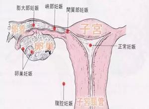 输卵管妊娠