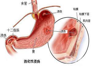 消化性溃疡