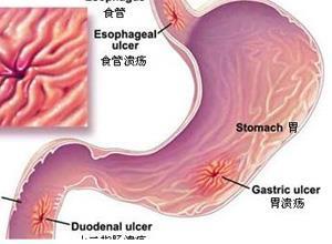 胃溃疡