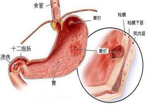 萎缩性胃炎