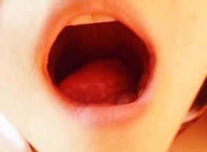 舌下腺囊肿