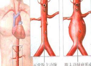 感染性腹主动脉瘤