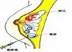 单纯性乳腺增生症