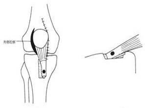 髌骨不稳定