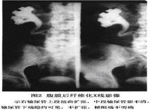 腹膜后纤维化