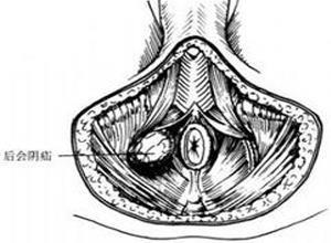 会阴疝
