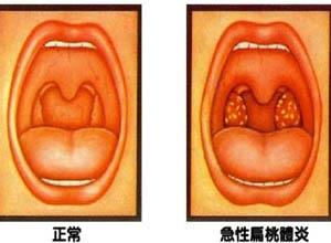 扁桃体炎