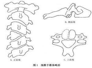 颈椎半椎体畸形