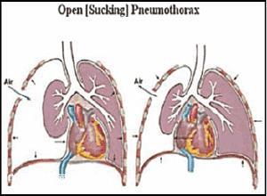 开放性气胸
