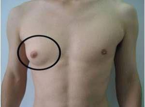 男子乳腺发育