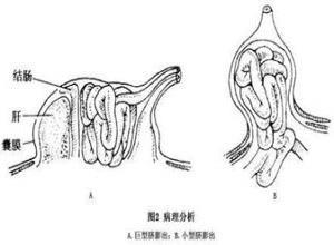 脐膨出