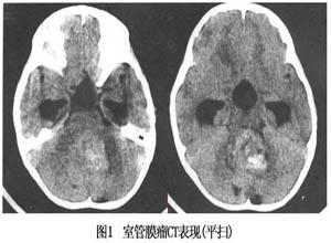 室管膜肿瘤