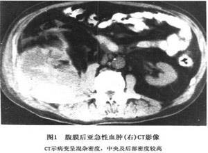 外伤性腹膜后出血或血肿